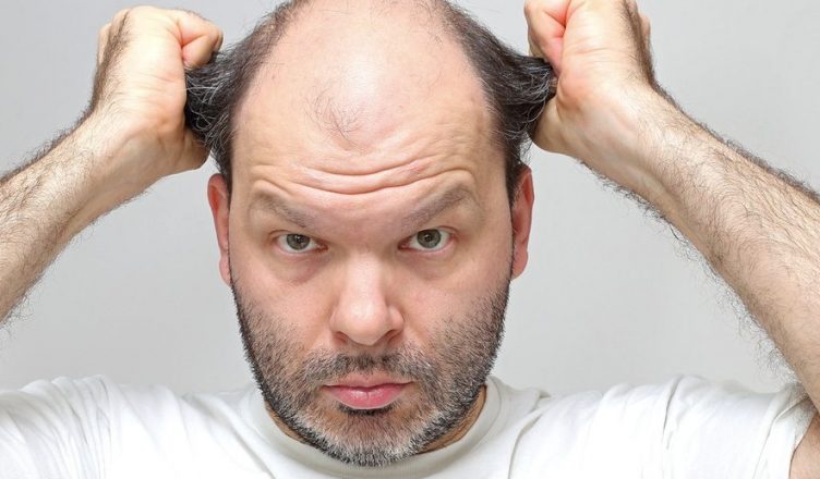 Alopecia da stress